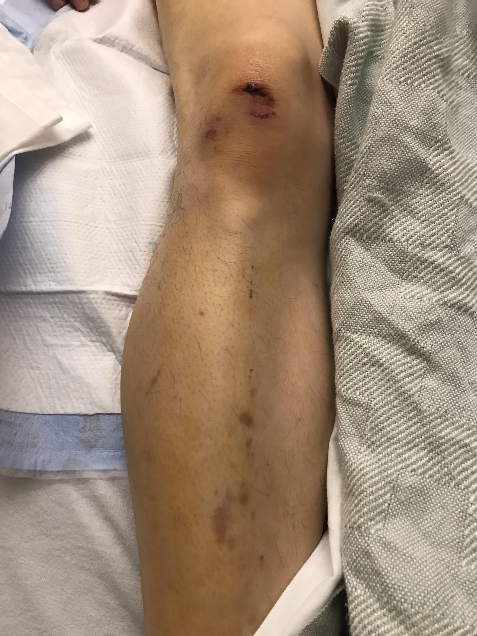 RightKneeandLegCutsandBruises Piccuta Law Group Car Accident Lawyers