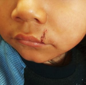 Photo showing injury to a child. 