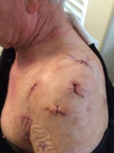 Multiple incisions were required for the surgery